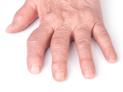 a kéz artrózisa és kezelő kenőcs)